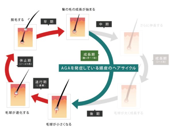 AGAを発症した頭皮のヘアサイクル