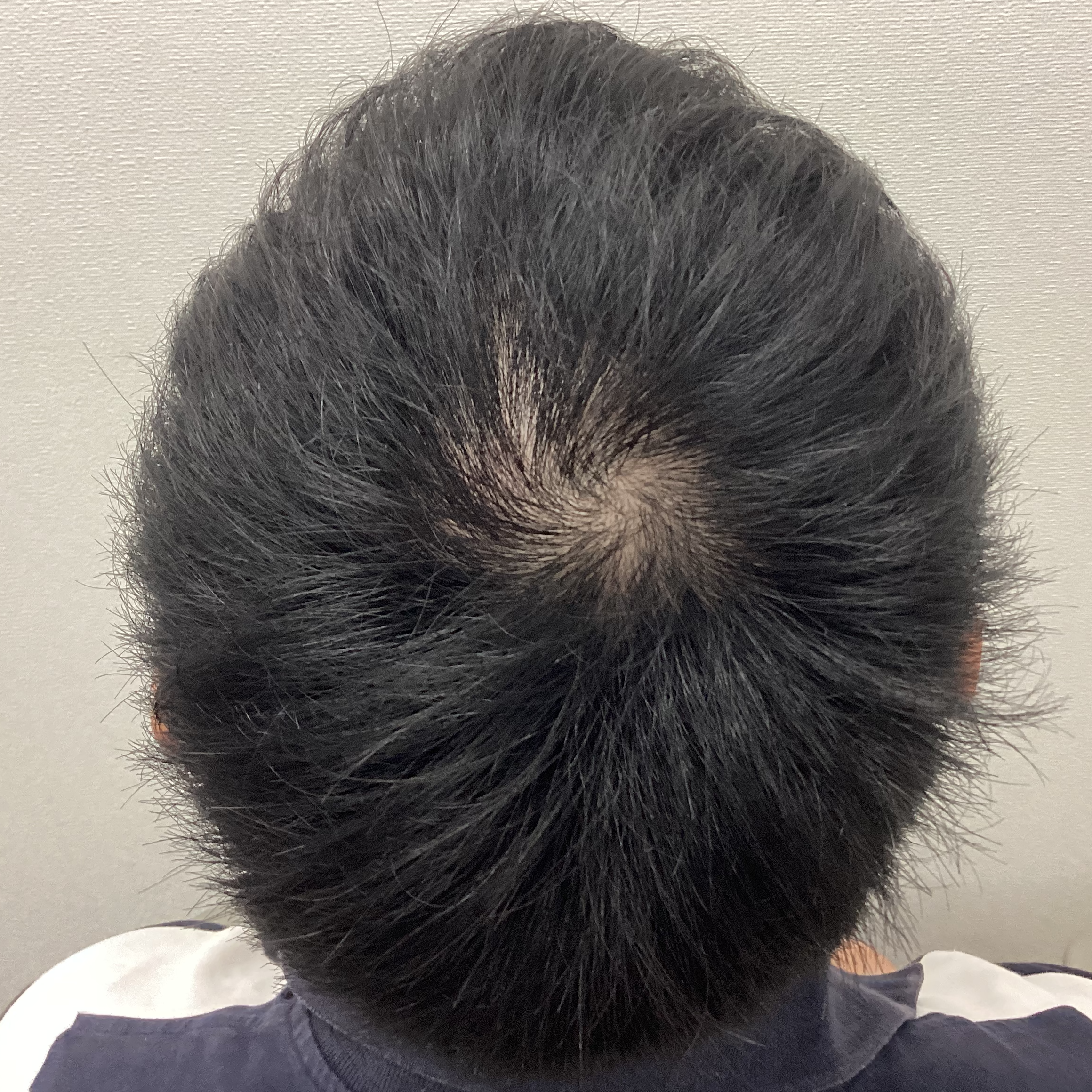 症例A 治療前の状態