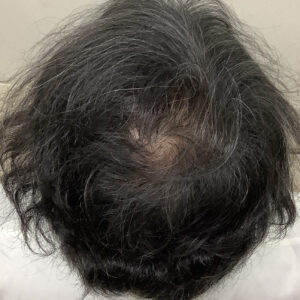 症例1 12ヶ月後：レーザー頻度低下により若干の減弱