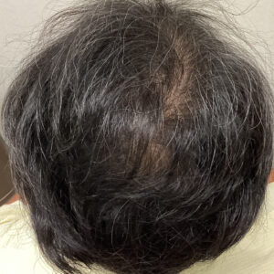 症例1 18ヶ月後：再びしっかりレーザーを行い薄毛を感じさせない状態に