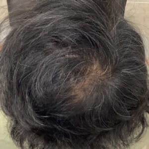 症例1 2ヶ月後：頭頂部の改善が見られる