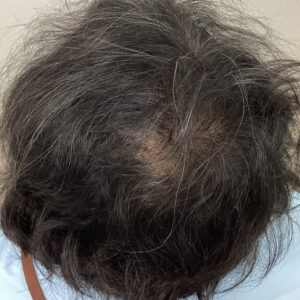 症例1 5ヶ月後：地肌がほとんど見えない状態に改善