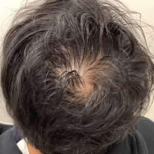 症例1 治療前：頭頂部に地肌が見える状態