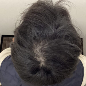 症例2 3ヶ月後：頭頂部の地肌が見えづらくなり著明に改善