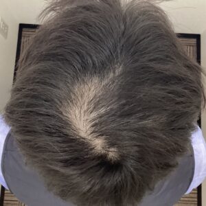 症例2 治療前：頭頂部に軽度〜中等度の薄毛